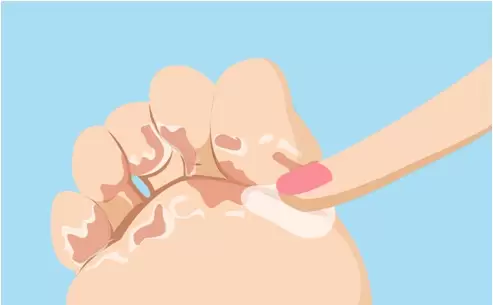Fungal skin infection treatment and prevention guidance