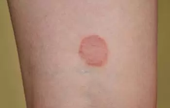 Fungal skin infection such as ringworm