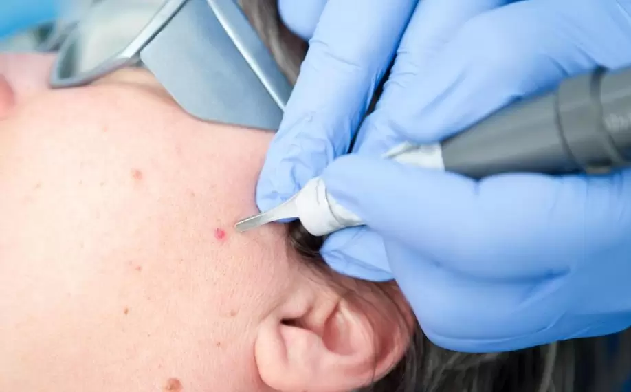 Electrocautery treatment in Chennai