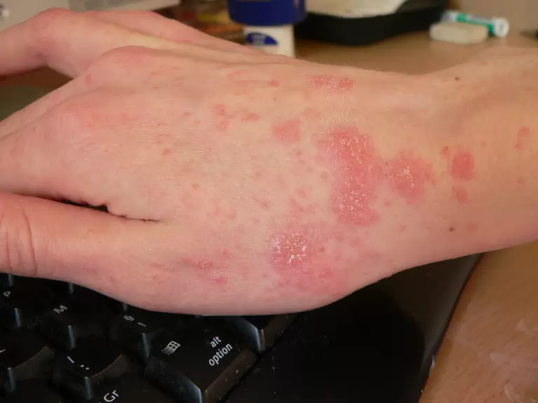 Scabies Treatment in Chennai