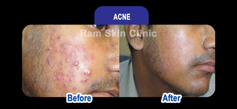 acne treatment in chennai