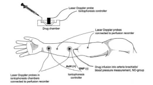 Iontophoresis Treatment in Chennai for Skin - Affordable Iontophoresis ...