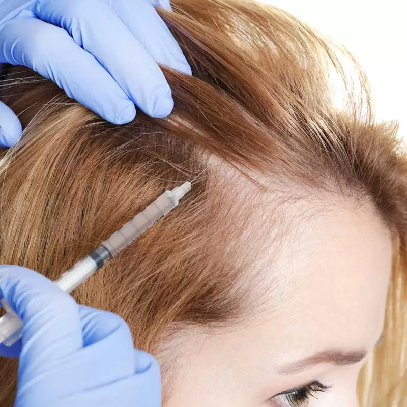 Alopecia Areata Treatment in Chennai
