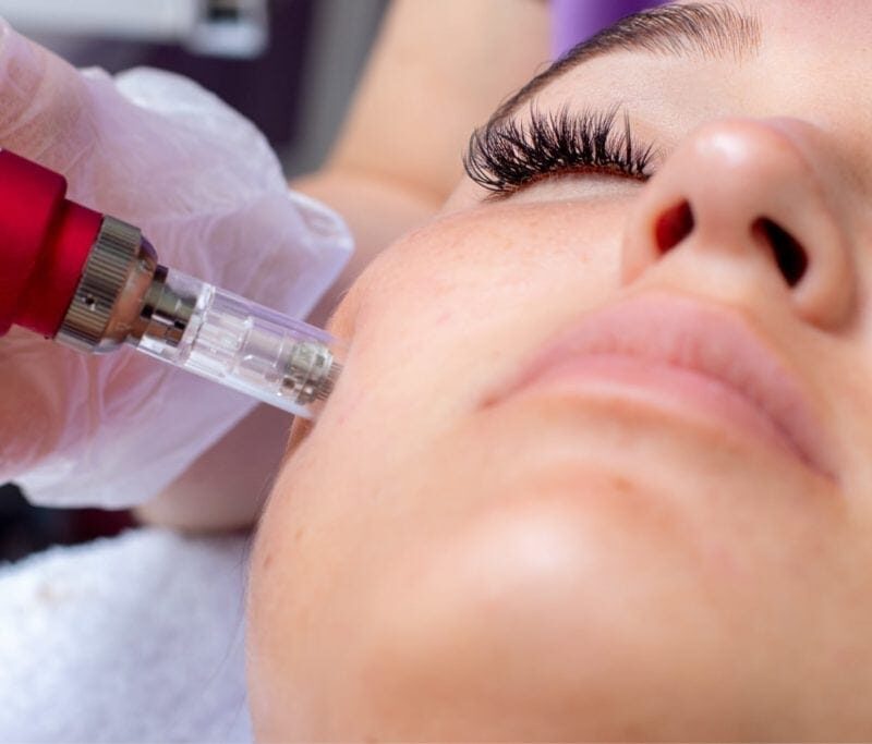 MNRF treatment in chennai