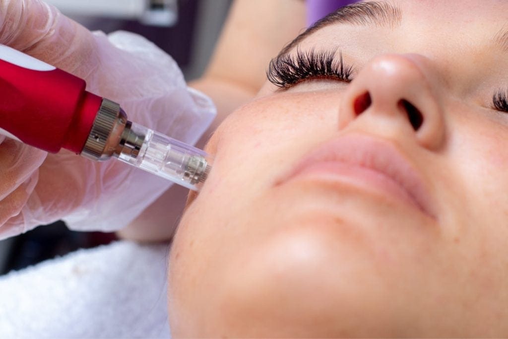 MNRF treatment in chennai