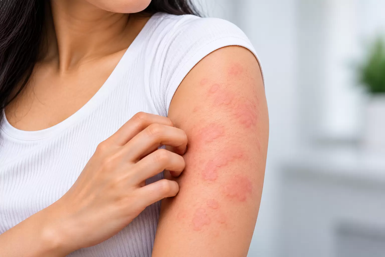 Urticaria treatment in Chennai