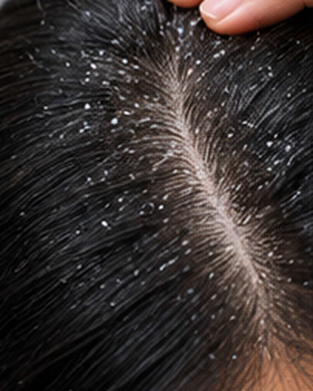 Dandruff treatment consultation at Ram Skin Clinic in OMR, Chennai