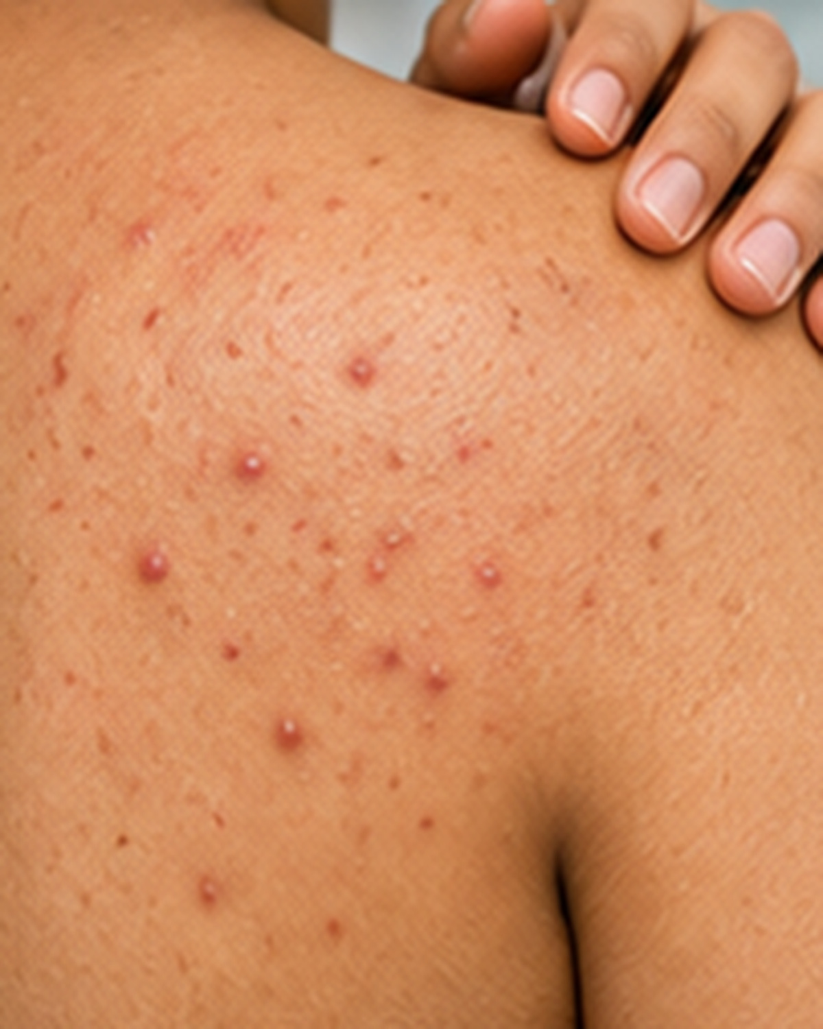 Folliculitis treatment consultation at Ram Skin Clinic in OMR, Chennai