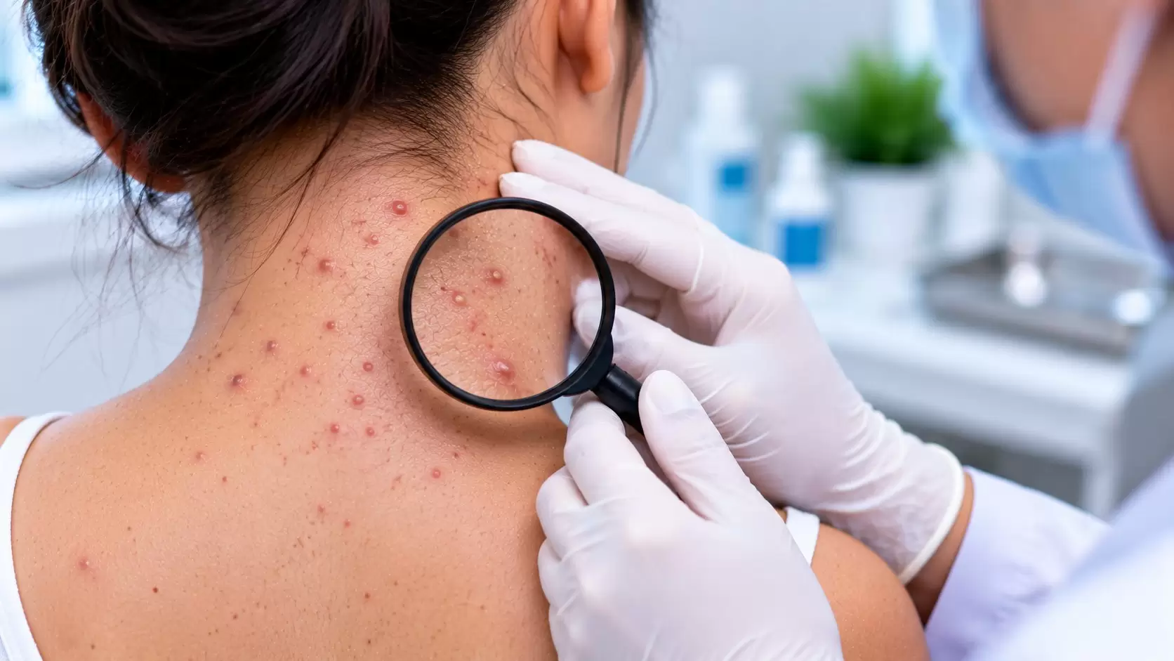 Folliculitis vs acne differences in follicular bumps