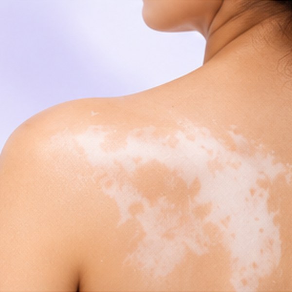 Pigmentation treatment in Chennai