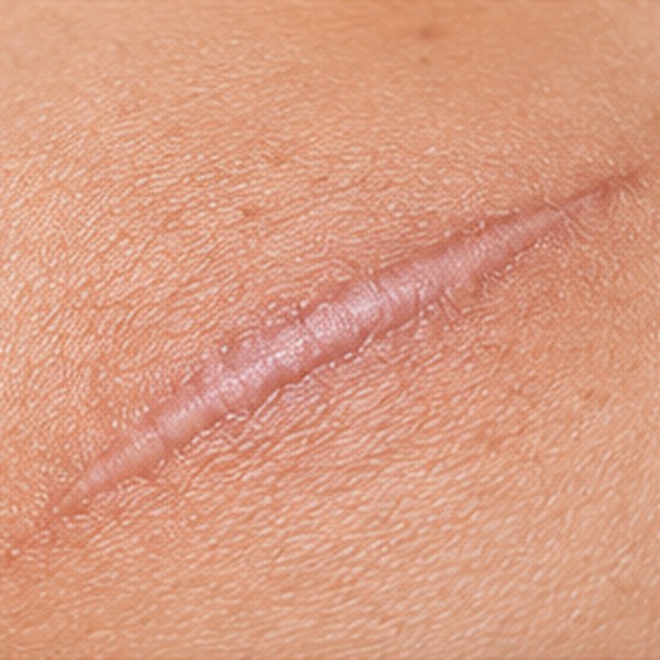 Scar treatment and dermatology consultation in Chennai