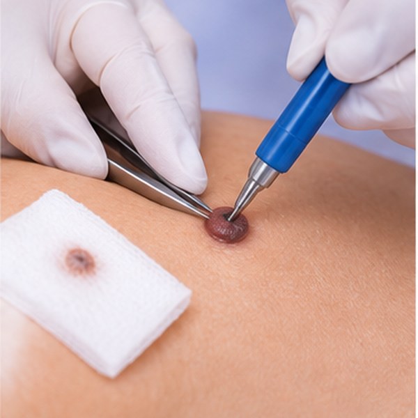 Skin biopsy procedure at Ram Skin Clinic Chennai