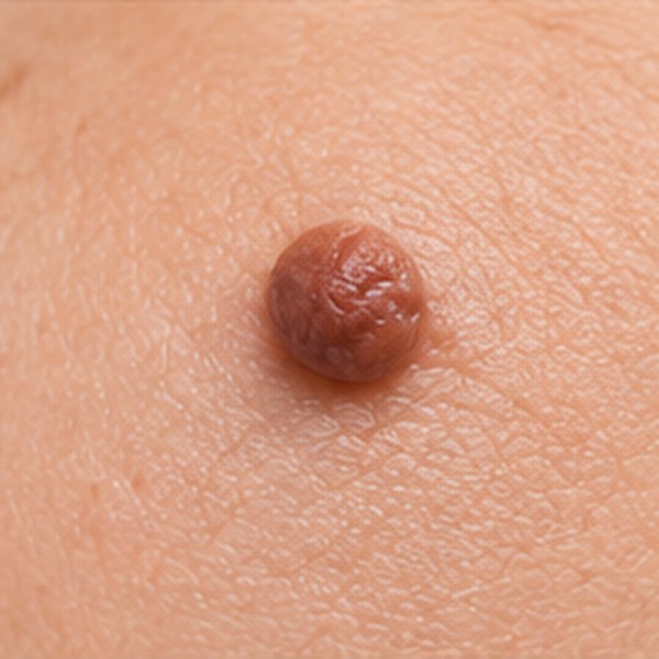 Warts and skin growth treatment in Chennai